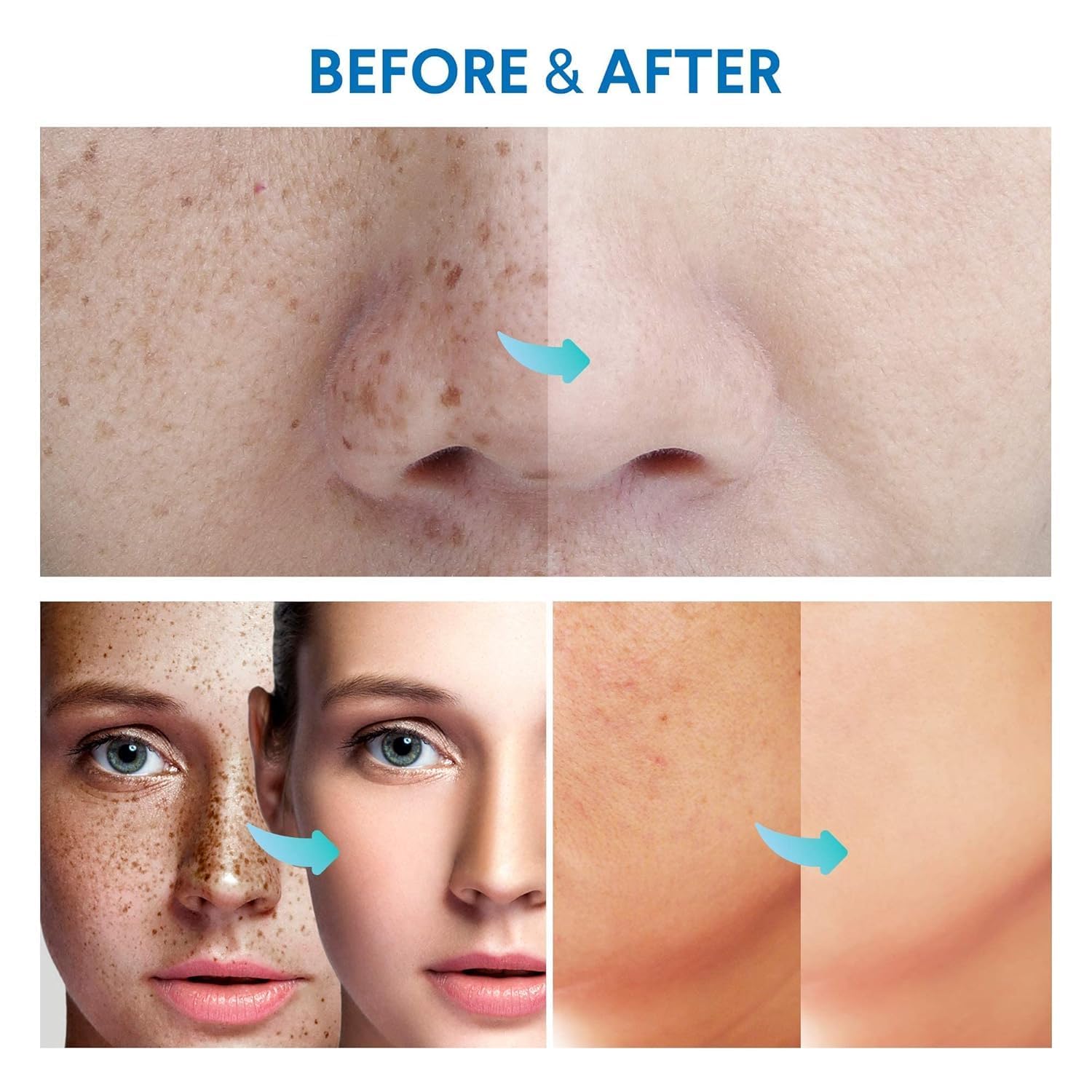 Razor Bump Treatment - Stop Ingrown Hairs & Burns -7 Razor Bump Treatment - Stop Ingrown Hairs & Burns -7