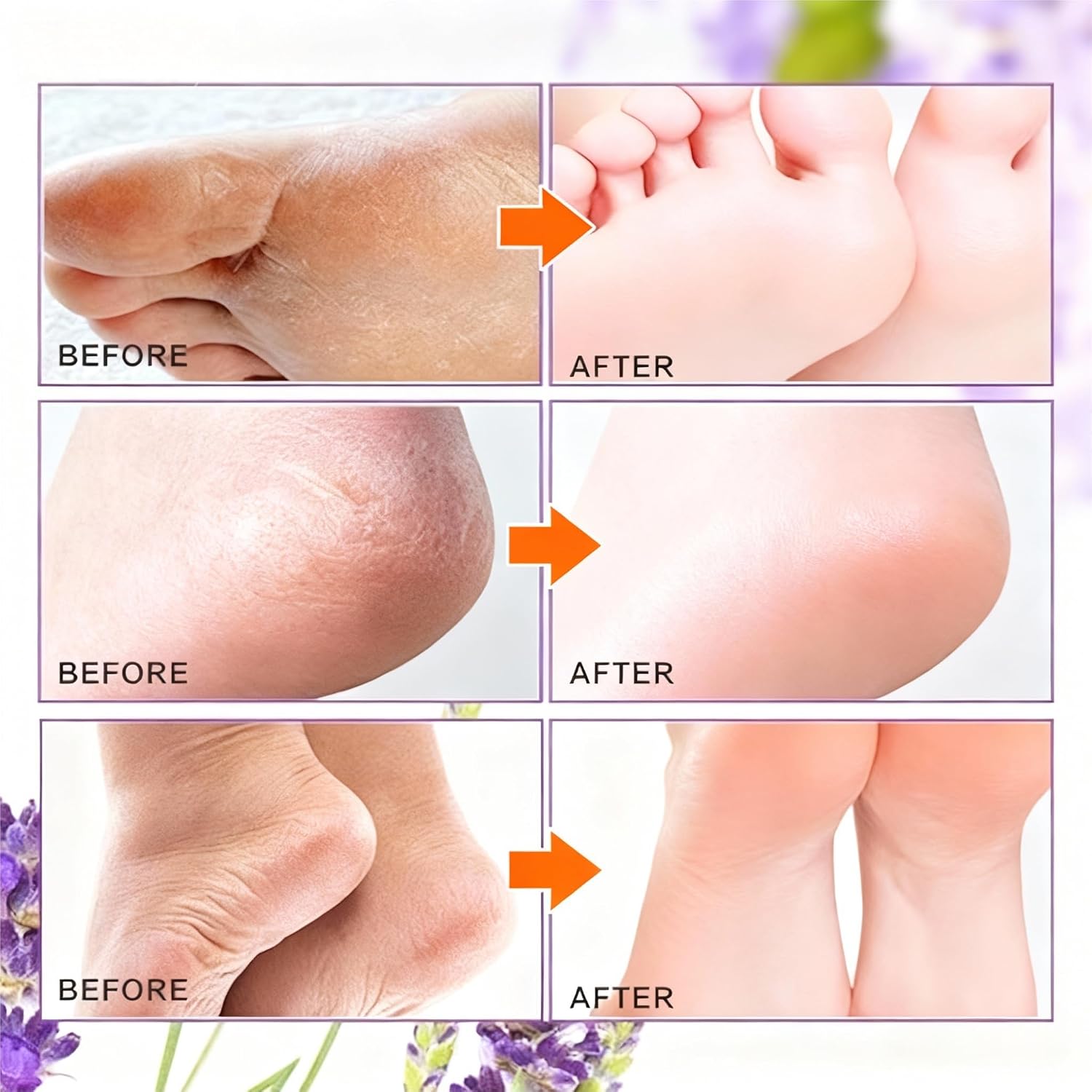 Peeling Foot Mask 5 Pack | Lavender Extract Foot Peel for Dead Skin Removal & Heel Repair | Dermatologically Tested