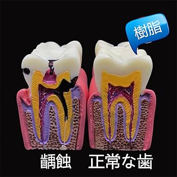 歯科　サンプル模型　6個セット(ゴールドCr,In,On,等) Amazon.co.jp: 歯列模型 6倍の倍率歯科モデル上顎/下顎模型 大型