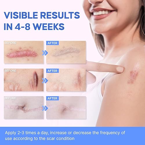 Miniatura 2 de Crema avanzada de silicona para eliminar cicatrices, gel quirúrgico para cicatrices de grado médico para cara y cuerpo, tratamiento de cicatrices