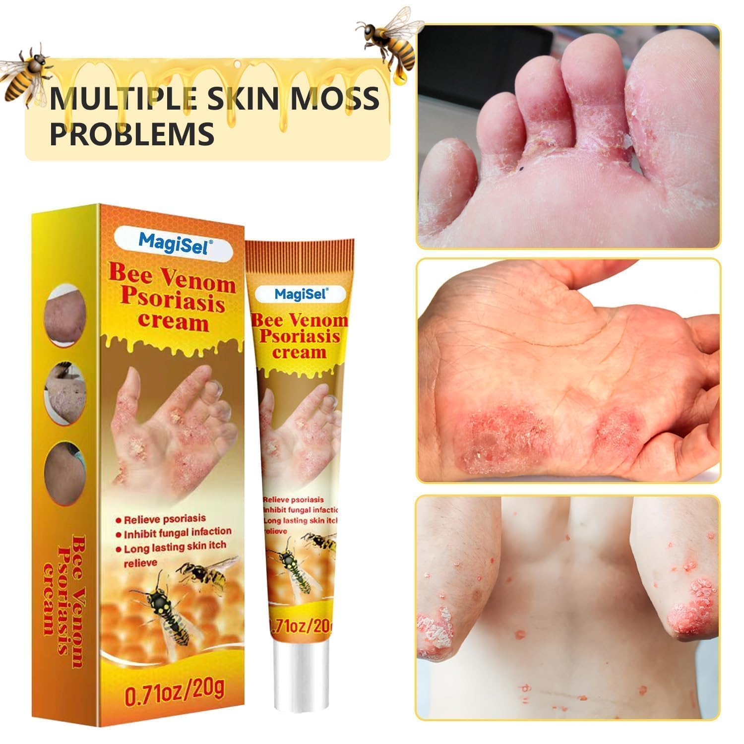 2 Pezzi Crema Antiprurito Al Veleno D'Api 30g – Sollievo Per Psoriasi, Rossore E Pelle Secca – Formula Delicata Non Irritante