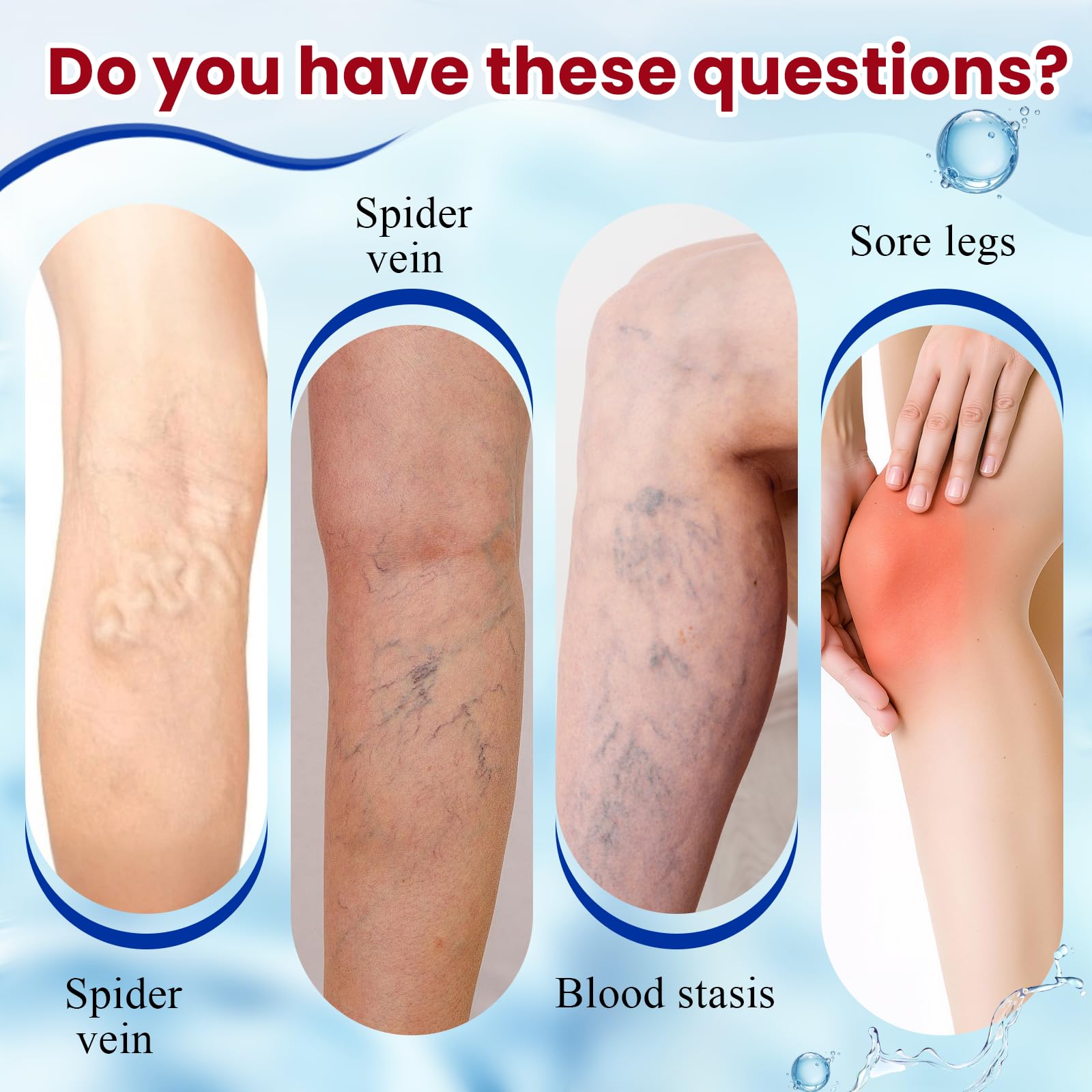 20g Crème pour Les Varices,Soulage Rapidement Les Jambes Fatiguées Et Lourdes,Facile à Utiliser