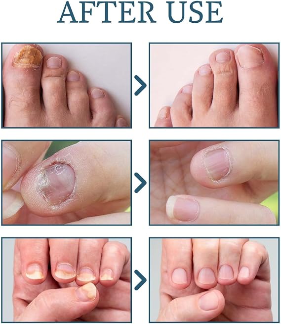 MAXIMUM Strength Nail Fungal Treatment - Toenail & Fingernail Fungus Eliminator - Repair, Strengthen, Fix & Renew Damaged Nails - 30ml