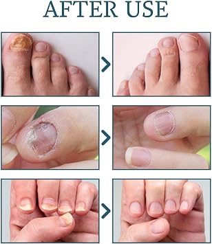 MAXIMUM Strength Nail Fungal Treatment - Toenail & Fingernail Fungus Eliminator - Repair, Strengthen, Fix & Renew Damaged Nails - 30ml