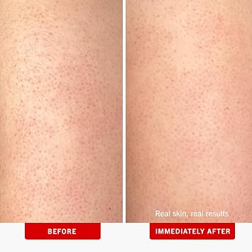 First Aid Beauty - KP Bump Eraser Body Scrub with 10% AHA, Keratosis Pilaris Exfoliater with Glycolic and Lactic acids, Helps Reduce Chicken Skin Bumps, Safe for Sensitive Skin, Strawberry Scent, 226g
