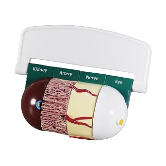 GPI Anatomicals 4-Piece Diabetes Model, Replica with Pathologies