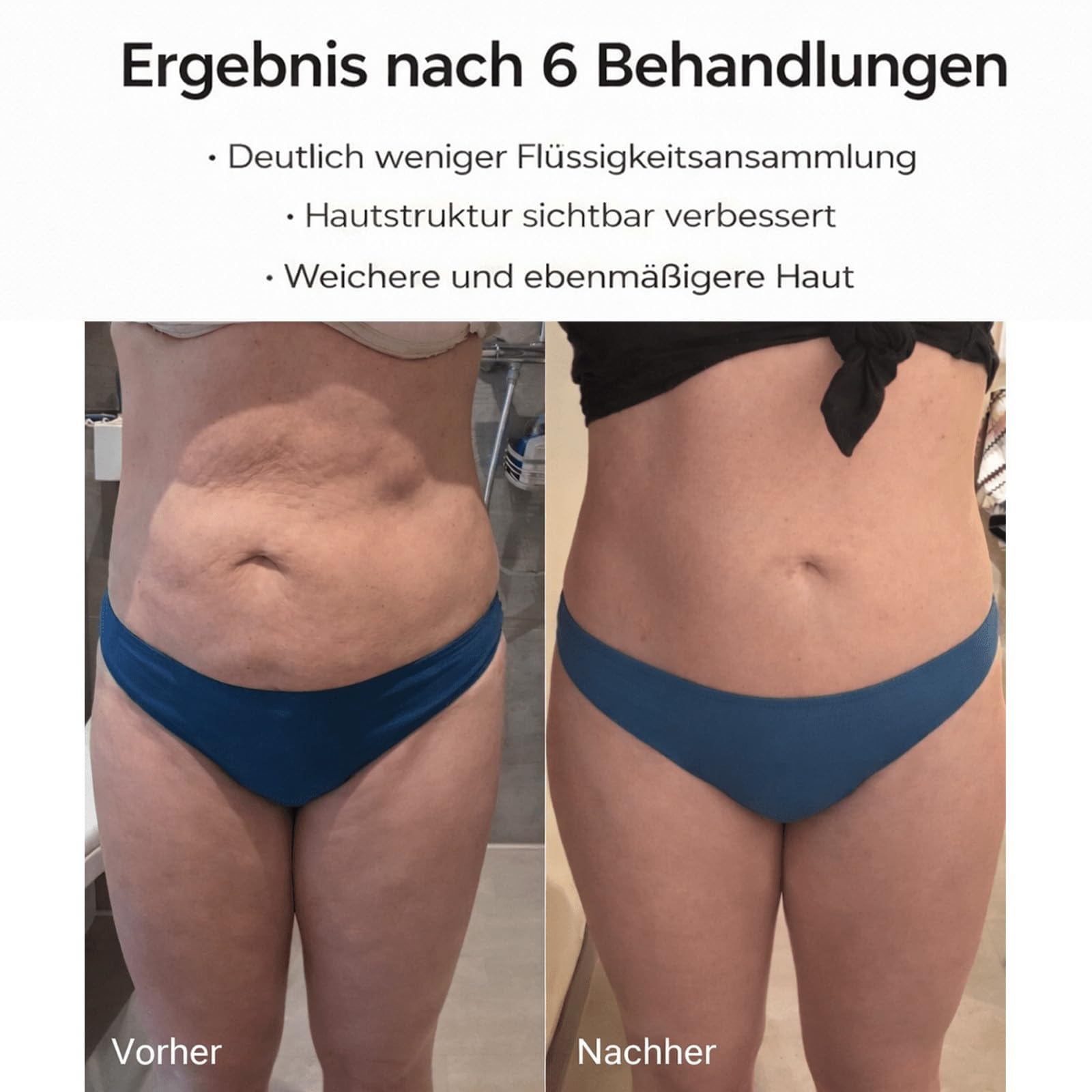 Celluviaa Gerät, Vacuvia Cellulite Massager, Celluviaa Cellulite-Behandlung, 4-in-1 – Vakuum Massagegerät mit Wärmetherapie zur Cellulite-Reduktion