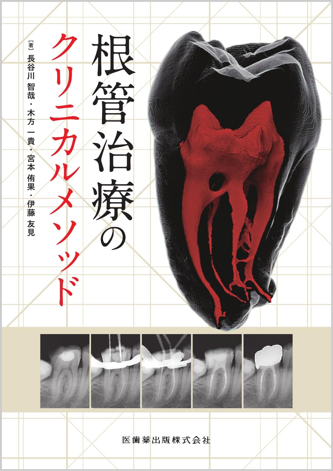 大臼歯までピッタリ根充を目指す国境の歯科医のクリニカル