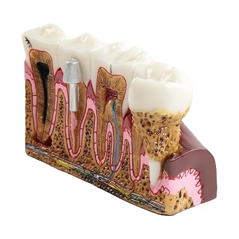 Dental Caries Tooth Anatomy Model with Common Dental Problems Oral Study | Comprehensive Structure Teaching Teeth Model,Students Gift