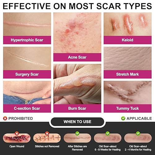 Miniatura 5 de Silicone Scar Sheets Medical Grade Silicone Scar Tape for Surgical Scars 1.77" x 120" 3M Wider Silicone Tape for Keloid Scar, Hypertrophic,