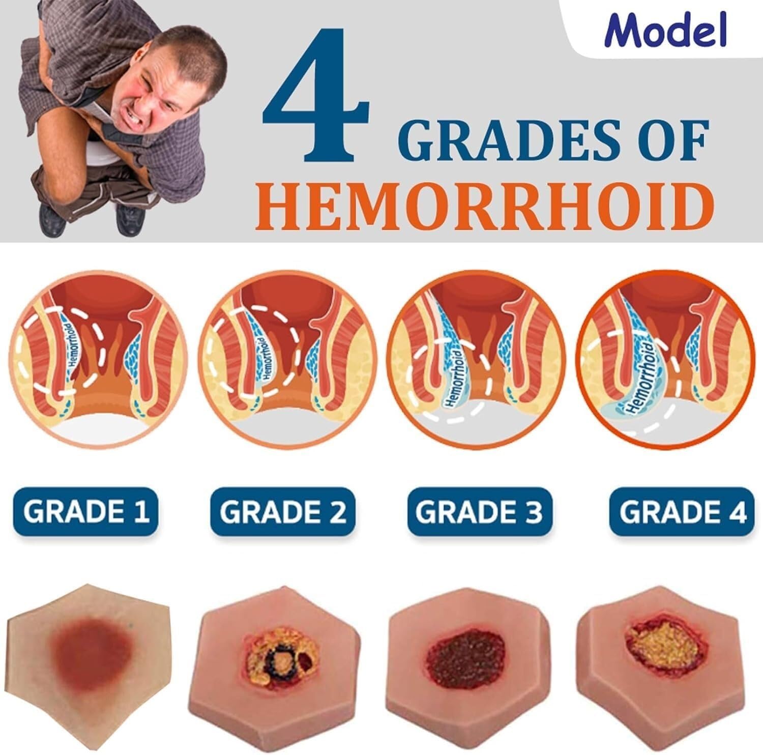 HEQIM Bedsore Wound Care Model, Bedsore 4 Stages, Bedsore Simulation Care Model, Medical Training Practice Model