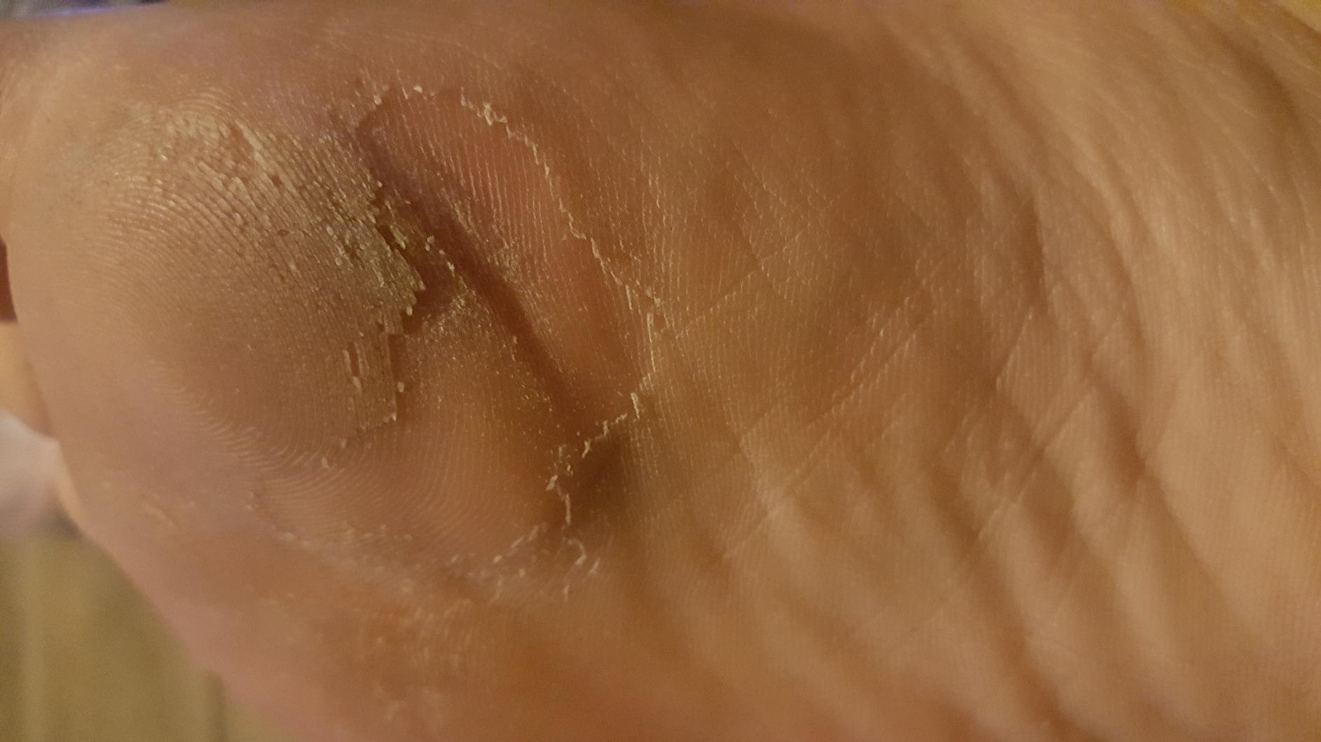 Purederm Exfoliating Heel Mask (1 Pair) – Heel Peeling masks gently remove calluses from your heel