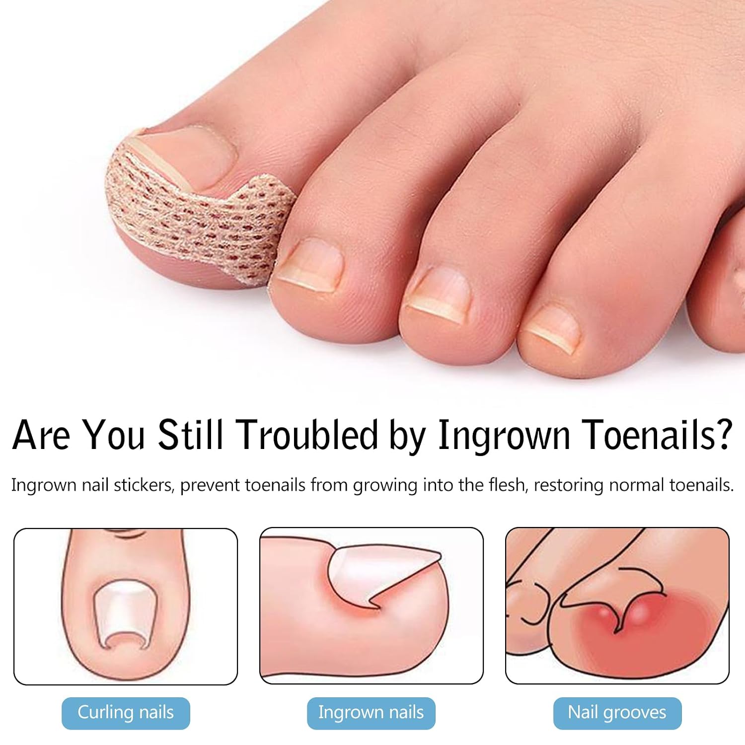 Ingrown Toenail Treatment, 100 Pcs Breathable Ingrown Toenail Strips,Painless Ingrown Toenail Tool, Professional Pedicure for Toenail Corrector Patch