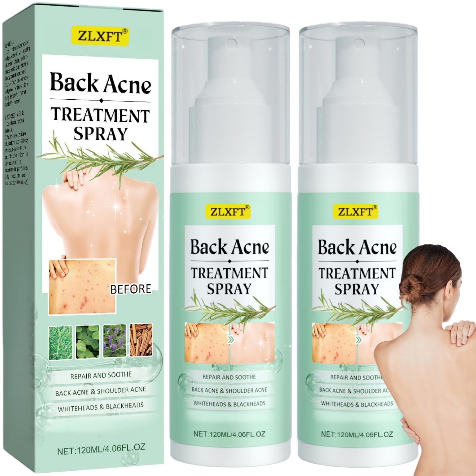 Torna Soluzione Brufolo,2pcs Spray per Brufoli Corpo,Spray per la Rimozione dei Brufoli Sulla Schiena,Post Acne Trattamento Sprays,Acnes Sprays Back And Chest,Body Acnes Sprayss