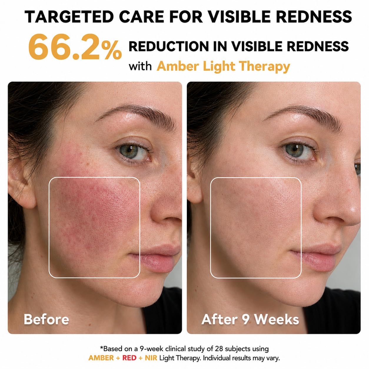 Red Light Therapy for Face, FDA-Cleared Blue Light Mask for Acne
