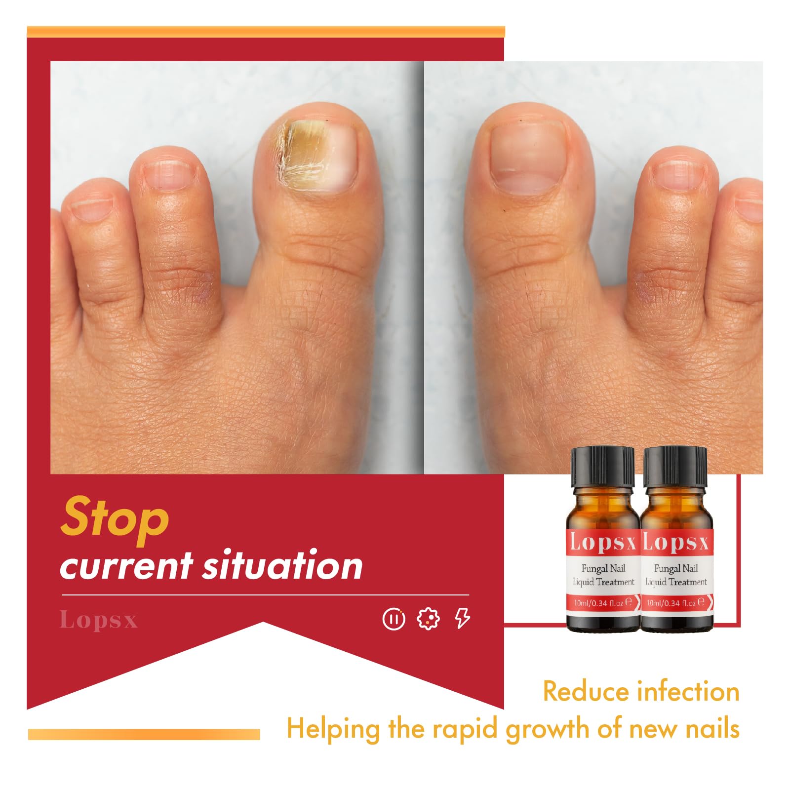 Traitement Puissant Contre La Mycose Des Ongles Des Pieds - 10 Ml En Gouttes - Neuf