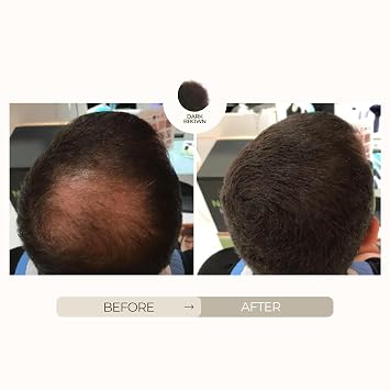 Hairatin Premium Hair Fibers - Dark Brown - for Thinning Hair, Keratin + Cotton Blend, Ammonia-Free Hair Thickener for Natural-Looking Fuller Hair in Seconds, Undetectable Long-Lasting Coverage