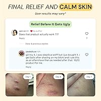 Vista 4 de MyMagicHealer Cuidado Universal para Inflamaciones Ungüento de Atracción para HS, Forúnculos, Quiste, Hemorroides, Quiste Pilonidal, Absceso