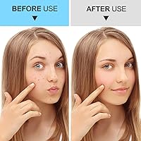 Vista 6 de Herramientas Removedoras de Puntos Negros Kit de Herramientas para Reventar Espinillas, Extractor de Comedones Kit de Eliminación de Acné