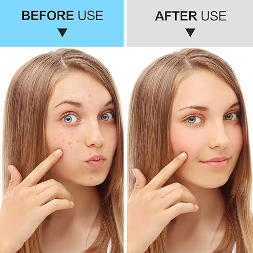 Miniatura 6 de Kit de herramientas para eliminar puntos negros, kit de herramientas para eliminar espinillas, kit de eliminación de acné para manchas, removedor de