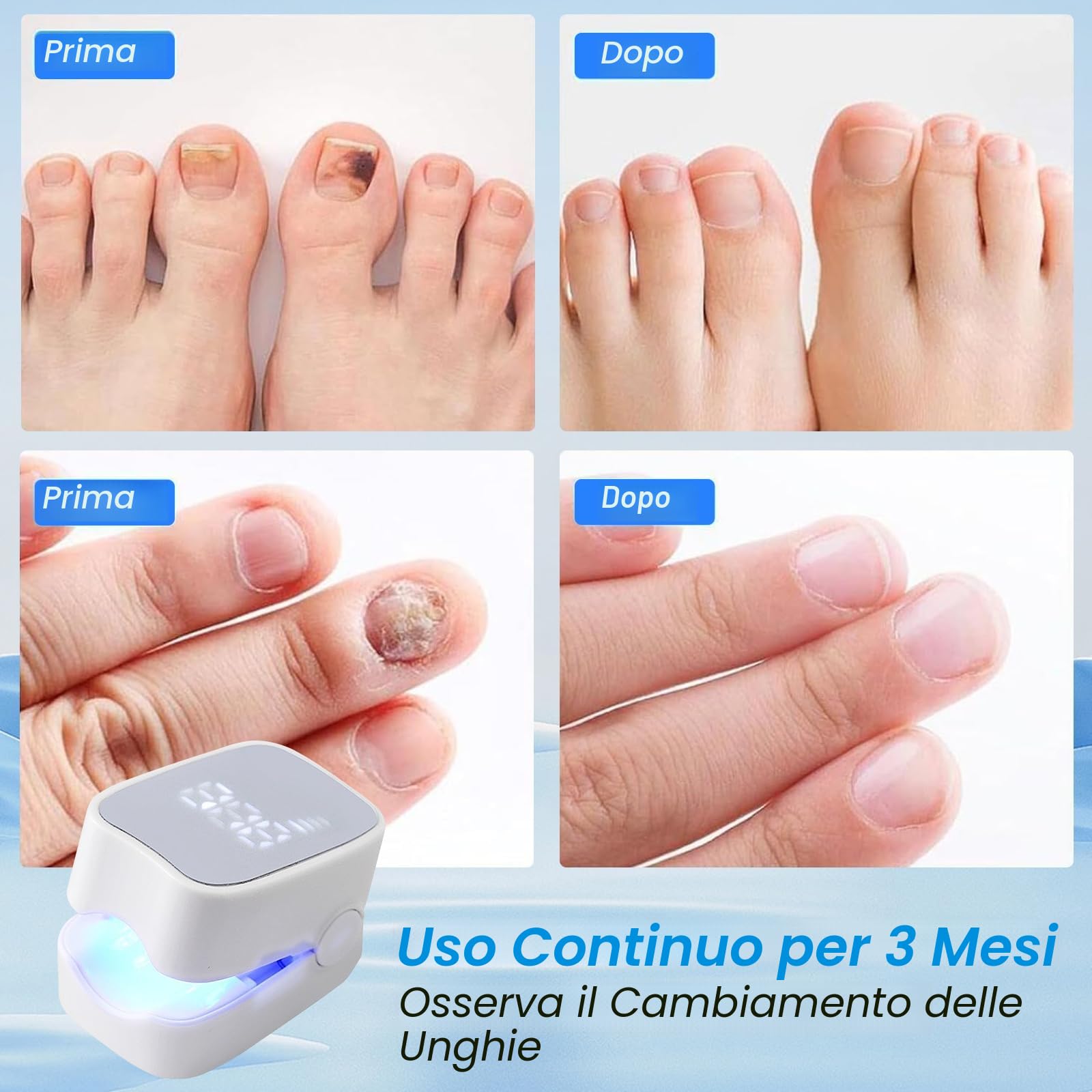 Mycose delle Unghie Laser, Mycose delle Unghie dei Piedi Pulizia e Riparazione Unghie, Dispositivo Trattamento Laser per Micosi delle Unghie dei Piedi, 7 Min al Giorno per Migliorare la Micosi Fungosa