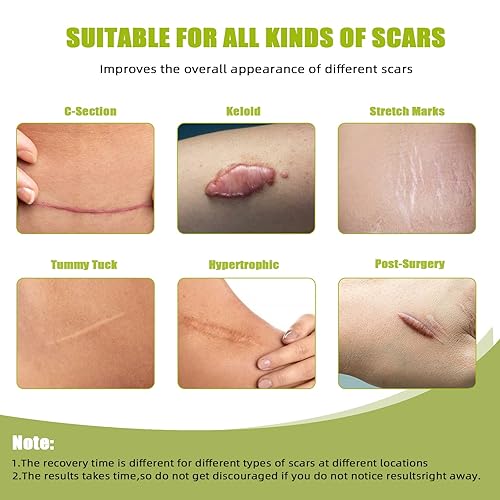 Miniatura 3 de Nepia Hojas de silicona para cicatrices de 1.6 x 120 pulgadas, rollo (3M)  Grado médico  Cinta de cicatriz reutilizable para aplanar y decolorar