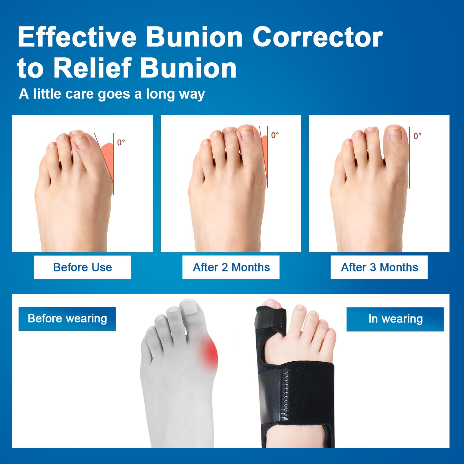 Hallux Valgus Korrektor für Frauen und Männer, Großzehenabstandhalter zur Linderung von Ballenzehen, Zehenspreizer für Hallux Valgus, 2 Einstellbare Korrektur, Korrektur, Zehenkorrektur