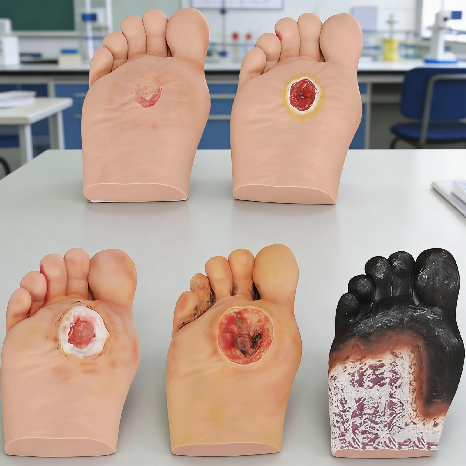 Modelo de pie diabético para demostraciones de cuidado de heridas, herramienta simuladora de lesiones purulentas grado 1-5 para anatomía y fisiología, 5 piezas para uso educativo