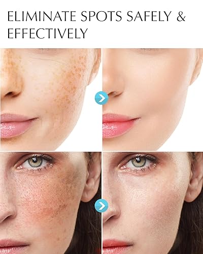 Miniatura 2 de Eliminador de manchas oscuras para rostro y cuerpo tratamiento de hiperpigmentación, ingrediente natural, pecas, melasma, manchas solares