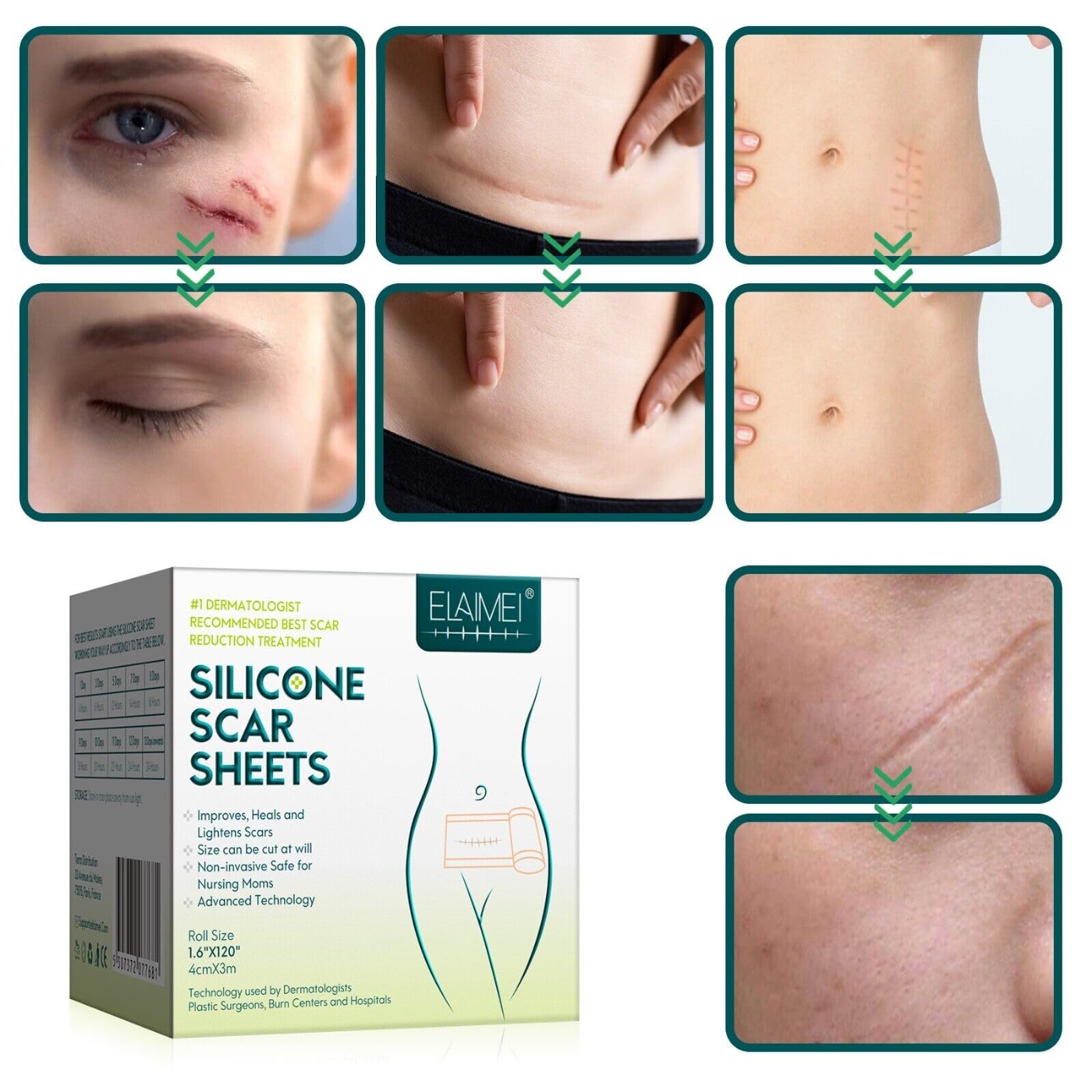 P-Beauty Silikonpflaster zur Narbenreduktion 4cm x 3,2m | Selbstklebendes, medizinisches Narbenpflaster | wiederverwendbar | gegen Akne, Keloid, OP & Verbrennungsnarben | Silikon Narbenrolle