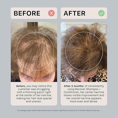 Miniatura 6 de ACTIIV Ultimate Scalp Trio  Alivia el cuero cabelludo seco y con picazón, reduce las escamas, fortalece e hidrata el cabello, incluye champú para la