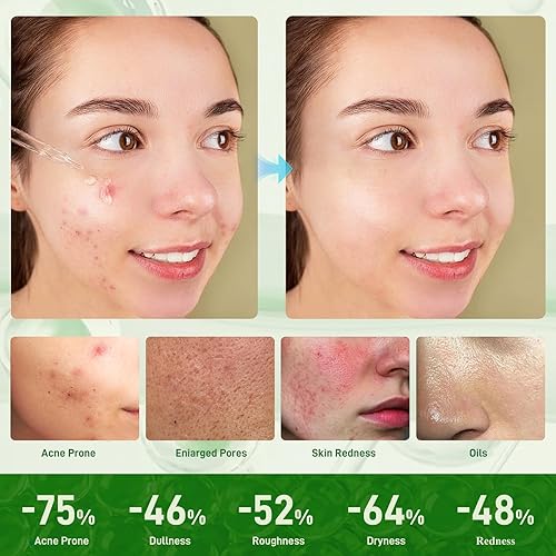 Miniatura 5 de Suero de tratamiento del acné con ácido salicílico al 2% y niacinamida-centella asiática aceites de reparación facial para piel sensible y propensa