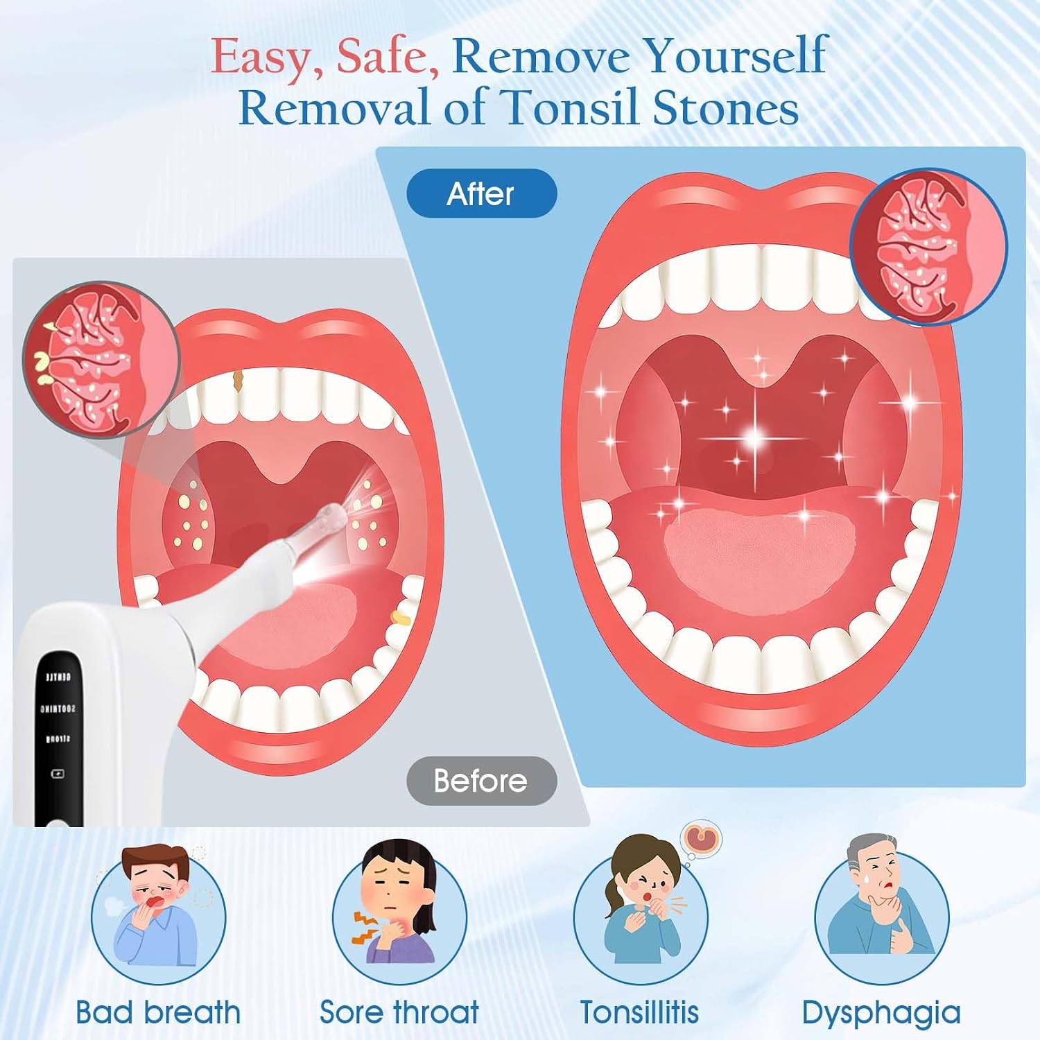 Upgraded Electronic Tonsil Stone Remover,lectronic Oral Care Cleaning Tool Set with 3-Speed Vacuum, 4 Soft Silicone Nozzles & LED Light for Fresh Breath & Comfortable Use (White)