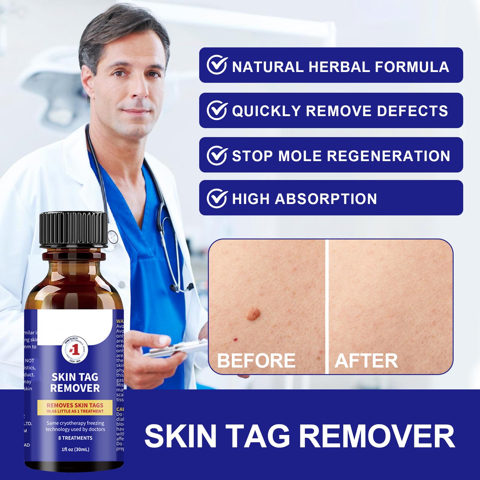 30ml Skin Tag Remover, Suavemente Las Verrugas Quitar Comunes, Mayoría de las Partes del Cuerpo, Fácil de Usar, Fórmula Suave