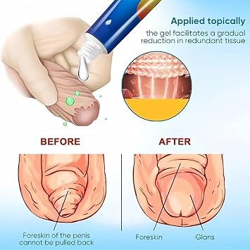 Phimosis Cream for Tight Foreskin, Gentle Correction Gel for Men Adults