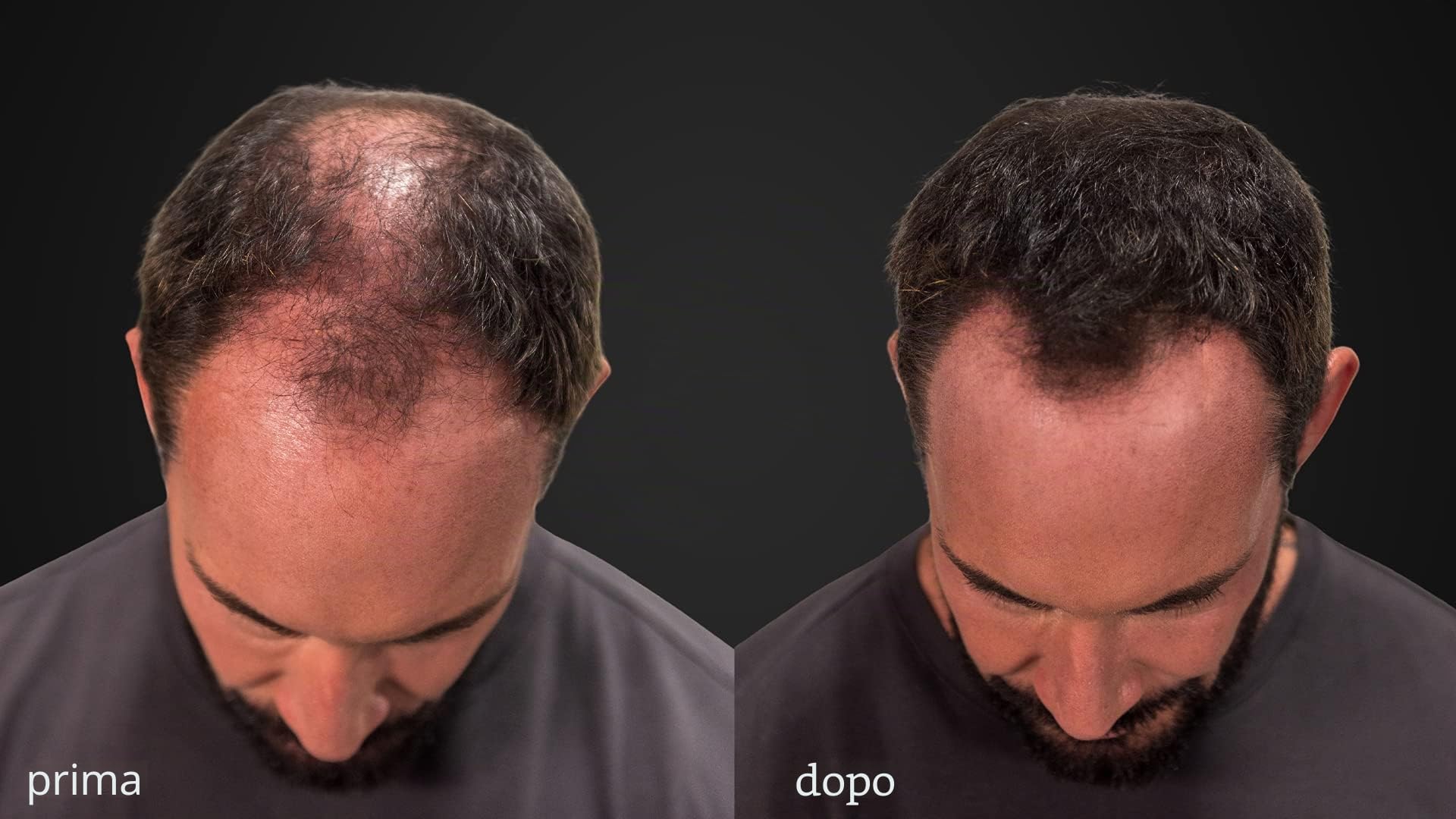 LUXE Fibre ispessimento capelli con cheratina naturale - Dura 2 mesi! - Testato da dermatologi – Ipoallergenico - Molteplici colori disponibili. Castano scuro