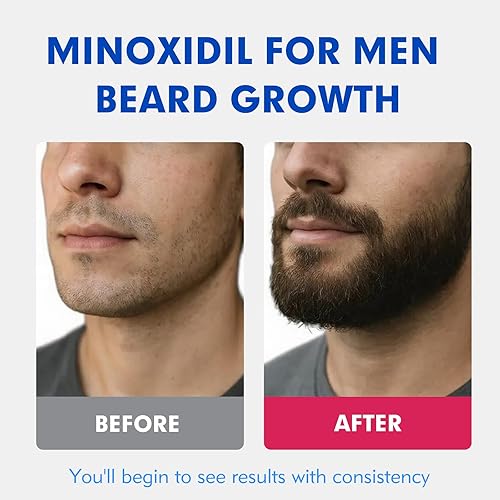 Miniatura 7 de 5% de minoxidil para hombres tratamiento de crecimiento del cabello, solución tópica extra fuerte para adelgazamiento del cabello y calvicie,