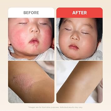 ATOPALM MLE Eczema Cream, 2.2 fl oz (65ml) | Premium Baby Lotion Newborn | Face & Body Moisturizer for Skin Barrier | Itchiness & Redness Care | Korean Skincare
