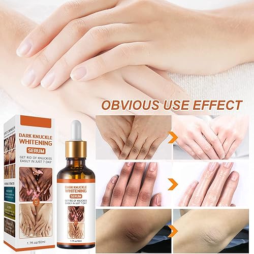 Miniatura 4 de Acanthosis Nigricans - Corrector de manchas oscuras para acantosis, manchas oscuras para aclarar la piel negra, suero iluminador de la piel, para