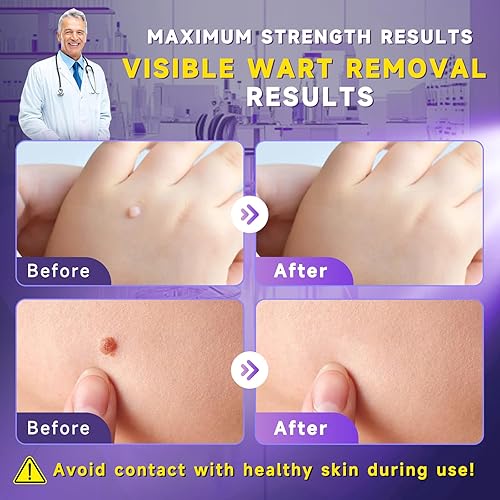 Miniatura 3 de TTsiya Eliminador de verrugas para congelar, removedor de marcas cutáneas de acción rápida con ácido salicílico, líquido para eliminar verrugas de