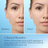 Vista 9 de Gel de tratamiento para el acné Differin, suministro de 30 días, tratamiento retinoide para la cara con 0.1% de adapalene, cuidado suave de la piel