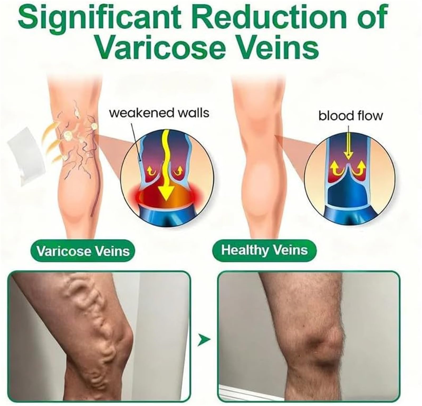Healrize cerotto microdarts per vene varicose, cerotti vene varicose e patch vene gambe, adesivi per capillari, formula naturale per uso quotidiano