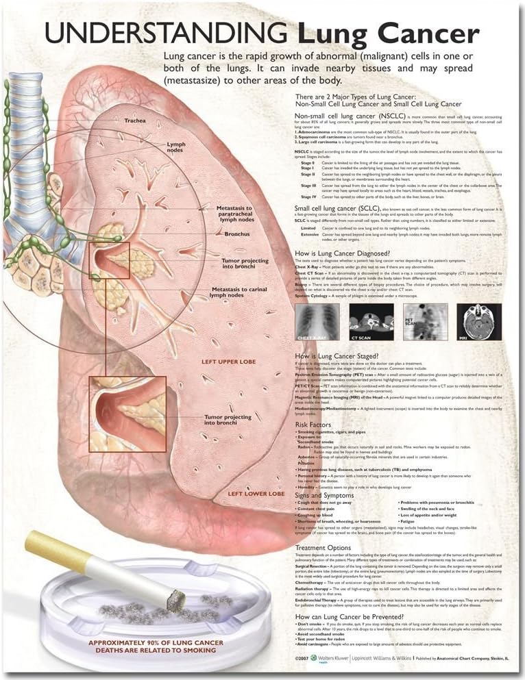 Understanding Lung Cancer Anatomical Chart