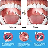 Vista 4 de Eliminador de piedras amígdalas mejorado con cámara, kit de eliminación visual de piedras amígdalas con 6 luces LED, cámara con herramienta