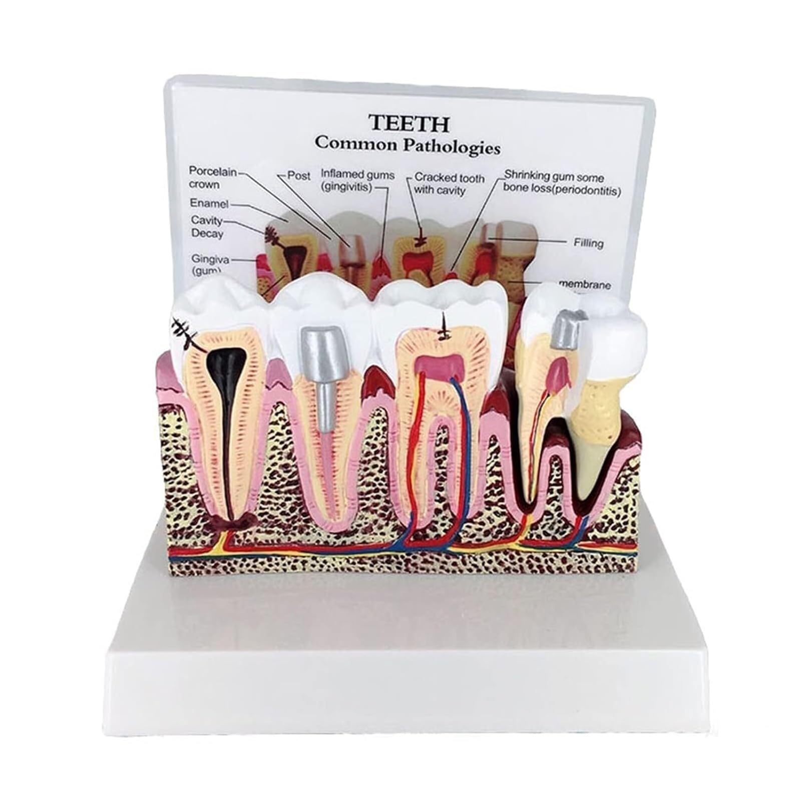 Modèle de dents d'éducation en anatomie dentaire – Modèle de section transversale des dents avec gencives dentaires amovibles pour affichage de pathologie, parfait pour les étudiants et les