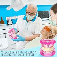Vista 5 de Modelo de dientes con enfermedad de Outus, modelo de implante dental con dientes removibles, estándar de dientes patológicos para demostración