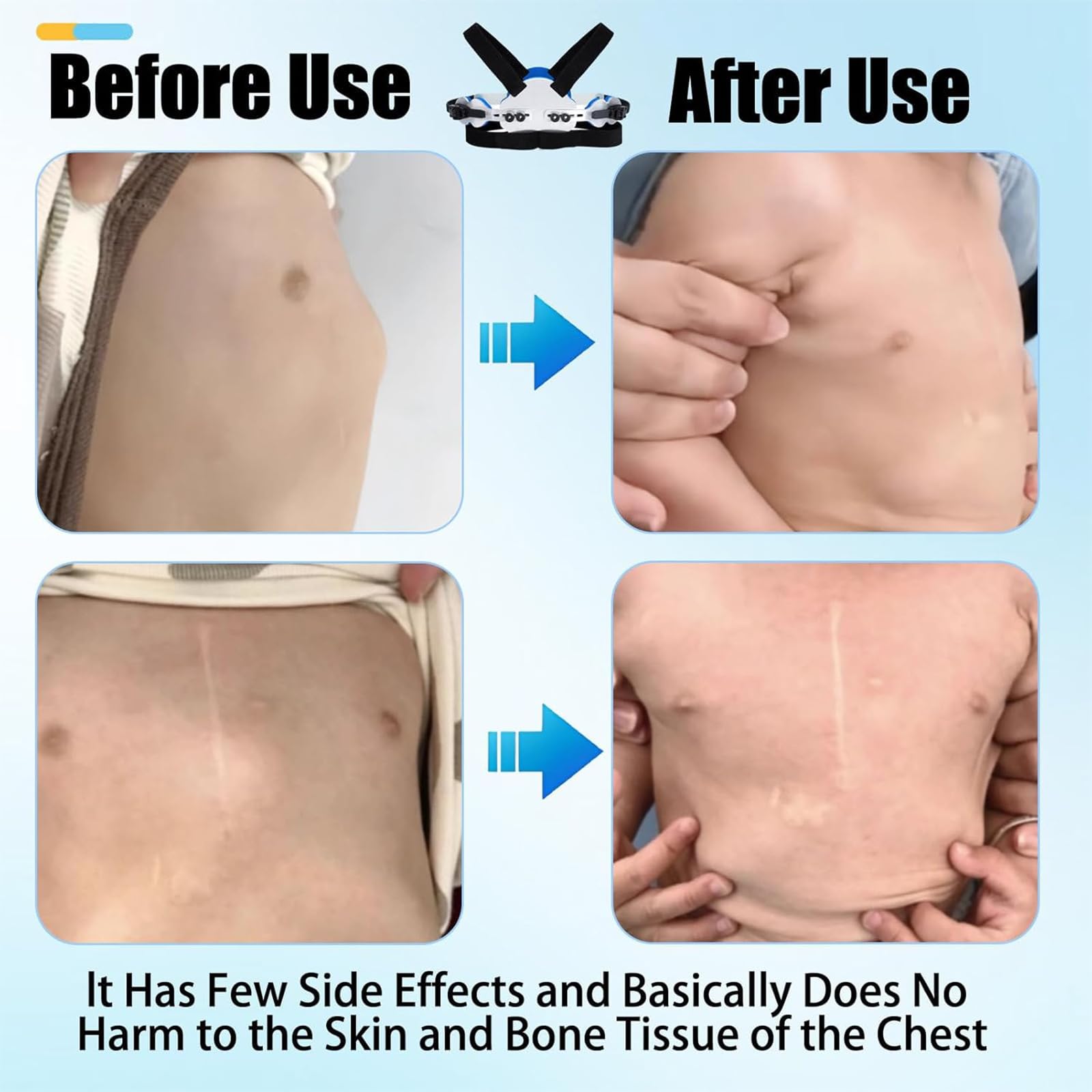 Ortesis Para Pectus Carinatum, Ortesis Para Costillas Valgas Con Correa Más Ancha, Ajuste Libre De Tamaño Y Agradable Para La Piel, Material De Aleación De Aluminio De Alta Resistencia, Para Niños.