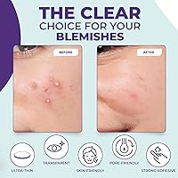 Vista 3 de Parches de espinillas para tratamiento de espinillas para cara, 36 parches invisibles para acné hidrocoloide con ácido salicílico, adhesivo