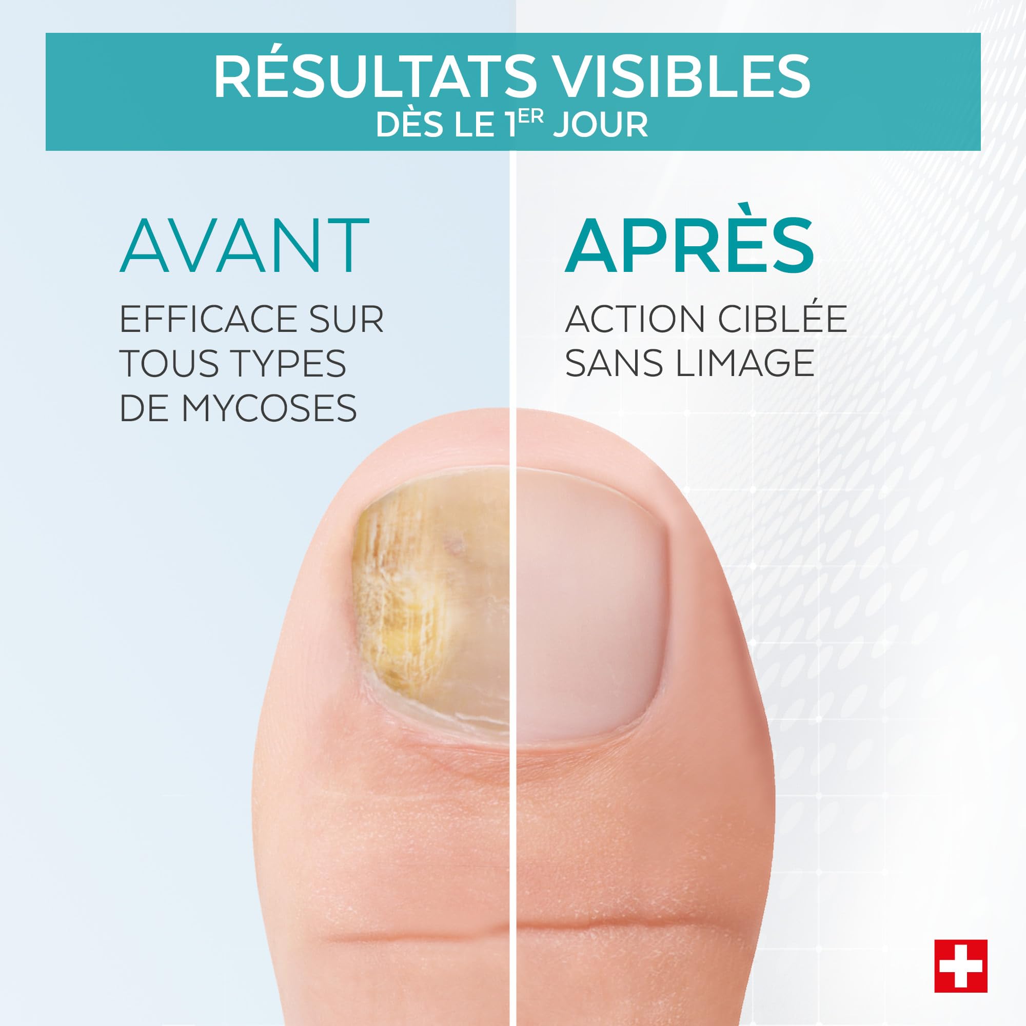 PODERM Stylo Mycose Ongles Des Pieds 4ML – Formule Vegan | Traitement 3en1 Elimine la Mycose | Nail Care Pen | 3 Secondes Par Jour et Résultats Rapides | Créé Par Une Podologue - Fabriqué en Suisse
