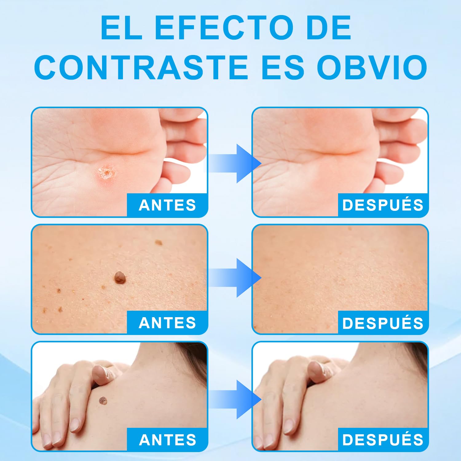 Removedor de verrugas de acción rápida para rostro y cuerpo - Lápiz con ácido salicílico y pincel de precisión | Fórmula suave para eliminar verrugas, tamaño viaje (2.5ml)